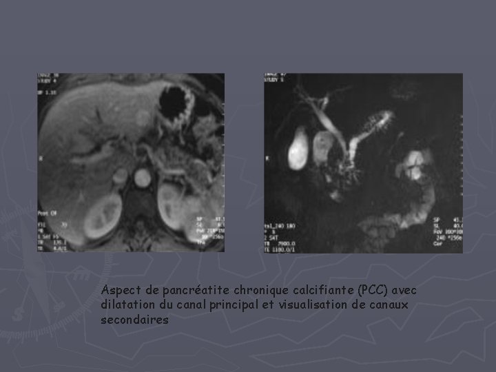 Aspect de pancréatite chronique calcifiante (PCC) avec dilatation du canal principal et visualisation de