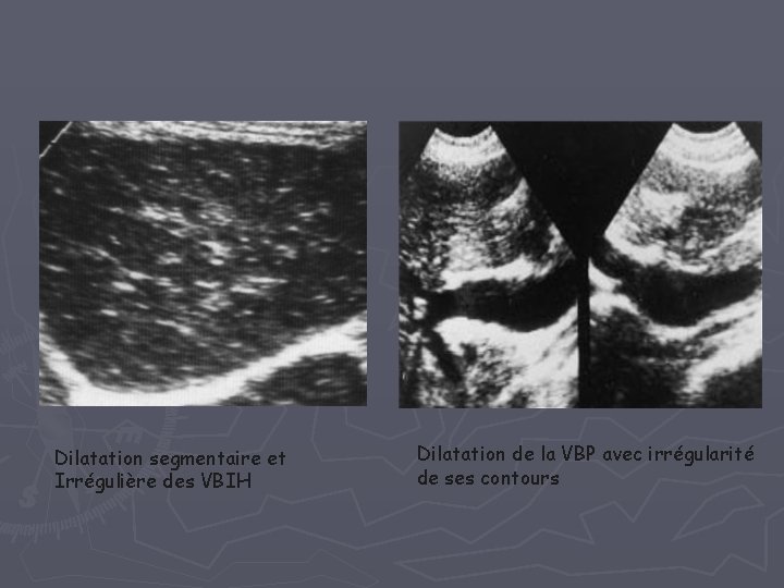 Dilatation segmentaire et Irrégulière des VBIH Dilatation de la VBP avec irrégularité de ses Dilatation segmentaire et Irrégulière des VBIH Dilatation de la VBP avec irrégularité de ses