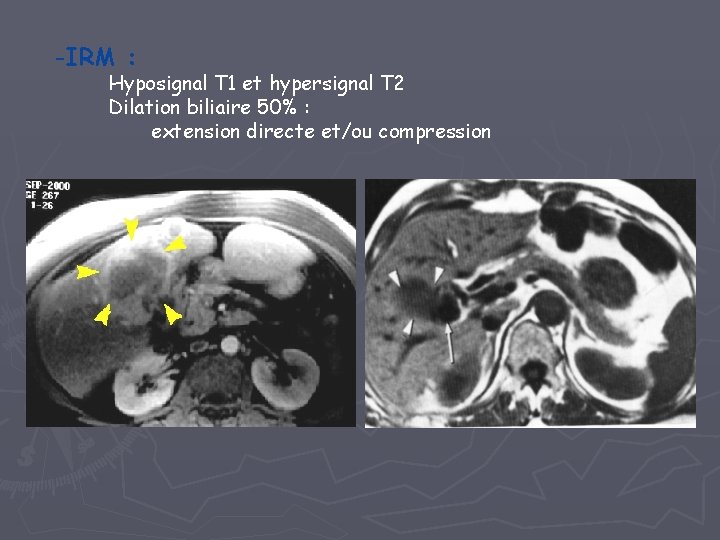 -IRM : Hyposignal T 1 et hypersignal T 2 Dilation biliaire 50% : extension