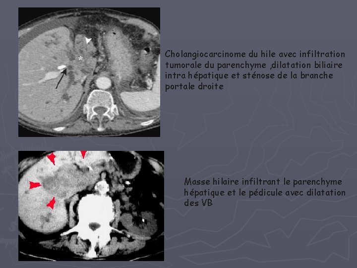 Cholangiocarcinome du hile avec infiltration tumorale du parenchyme , dilatation biliaire intra hépatique et Cholangiocarcinome du hile avec infiltration tumorale du parenchyme , dilatation biliaire intra hépatique et