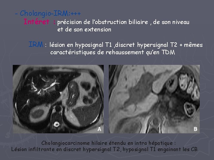 - Cholangio-IRM: +++ Intéret : précision de l’obstruction biliaire , de son niveau et - Cholangio-IRM: +++ Intéret : précision de l’obstruction biliaire , de son niveau et