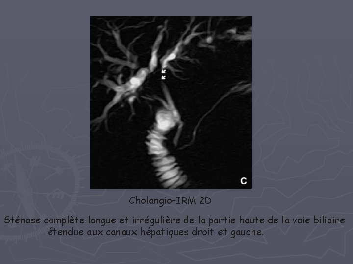 Cholangio-IRM 2 D Sténose complète longue et irrégulière de la partie haute de la Cholangio-IRM 2 D Sténose complète longue et irrégulière de la partie haute de la