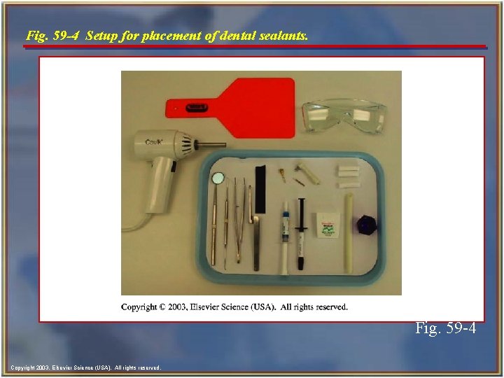 Fig. 59 -4 Setup for placement of dental sealants. Fig. 59 -4 Copyright 2003,