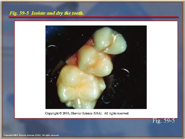 Fig. 59 -5 Isolate and dry the tooth. Fig. 59 -5 Copyright 2003, Elsevier