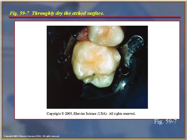 Fig. 59 -7 Throughly dry the etched surface. Fig. 59 -7 Copyright 2003, Elsevier