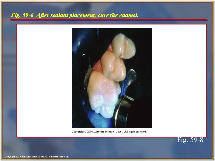 Fig. 59 -8 After sealant placement, cure the enamel. Fig. 59 -8 Copyright 2003,