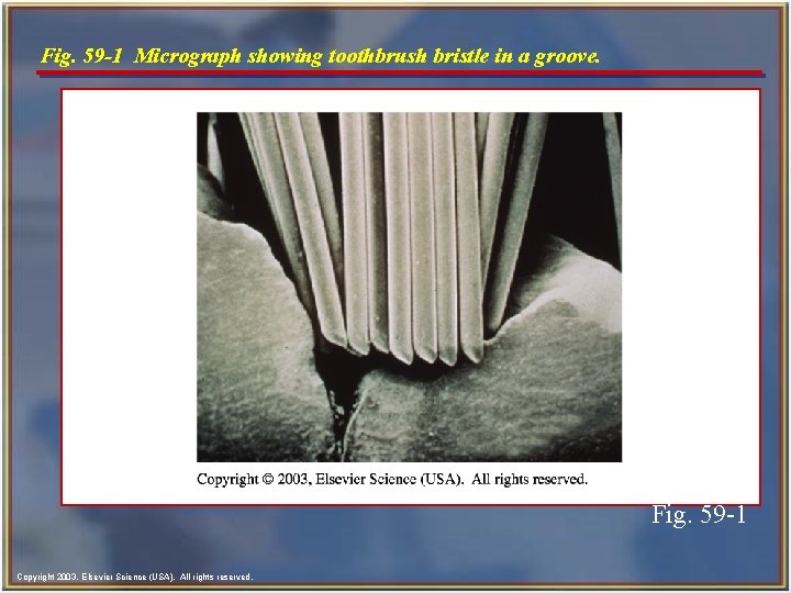 Fig. 59 -1 Micrograph showing toothbrush bristle in a groove. Fig. 59 -1 Copyright