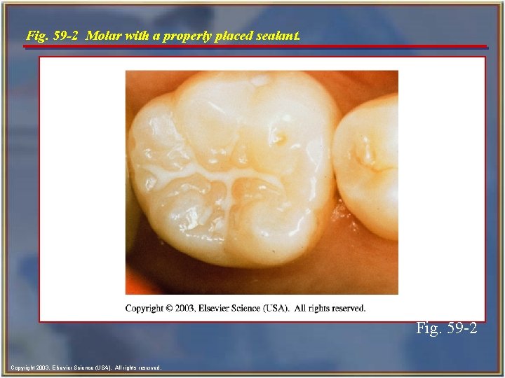 Fig. 59 -2 Molar with a properly placed sealant. Fig. 59 -2 Copyright 2003,