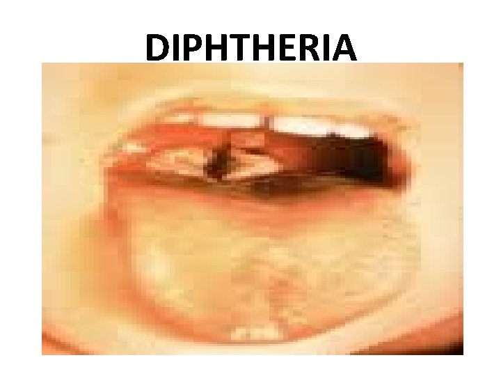 DIPHTHERIA 