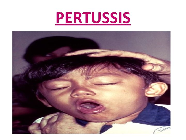 PERTUSSIS 