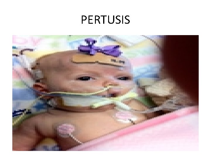 PERTUSIS 