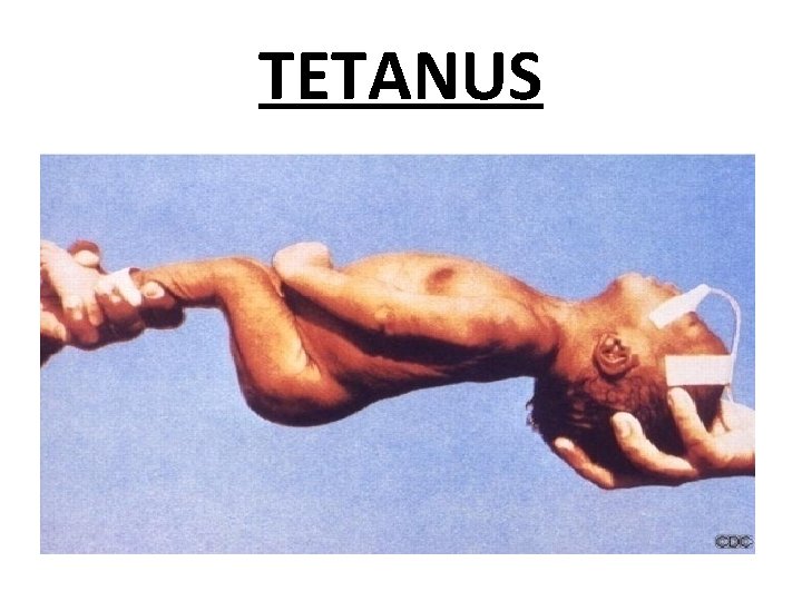 TETANUS 