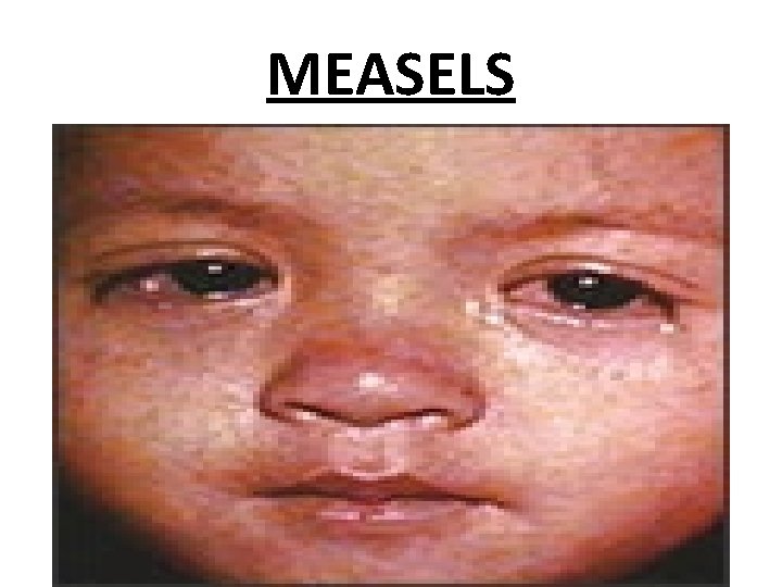 MEASELS 