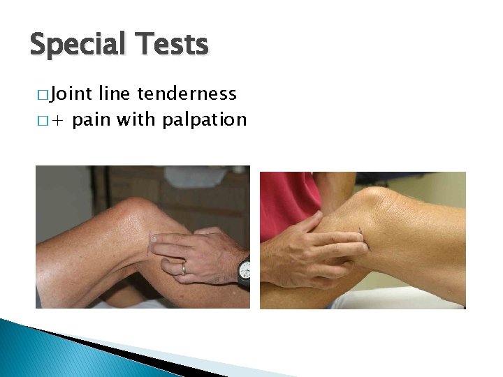 Special Tests � Joint line tenderness � + pain with palpation 