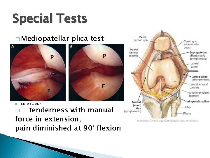 Special Tests � Mediopatellar � Kim et al. , 2007 �+ plica test tenderness