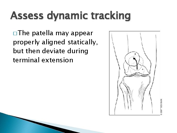 Assess dynamic tracking � The patella may appear properly aligned statically, but then deviate