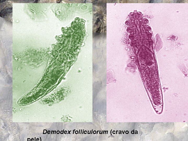 Demodex folliculorum (cravo da 