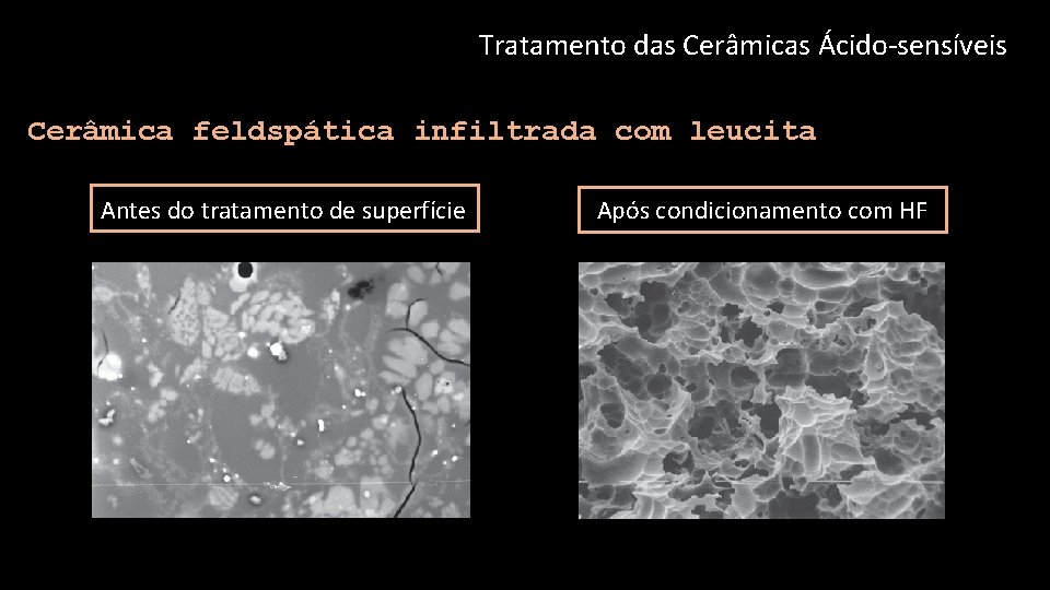 Tratamento das Cerâmicas Ácido-sensíveis Cerâmica feldspática infiltrada com leucita Antes do tratamento de superfície