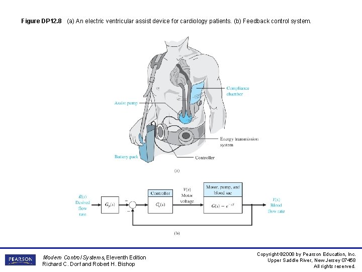 Figure DP 12. 8 (a) An electric ventricular assist device for cardiology patients. (b) Figure DP 12. 8 (a) An electric ventricular assist device for cardiology patients. (b)