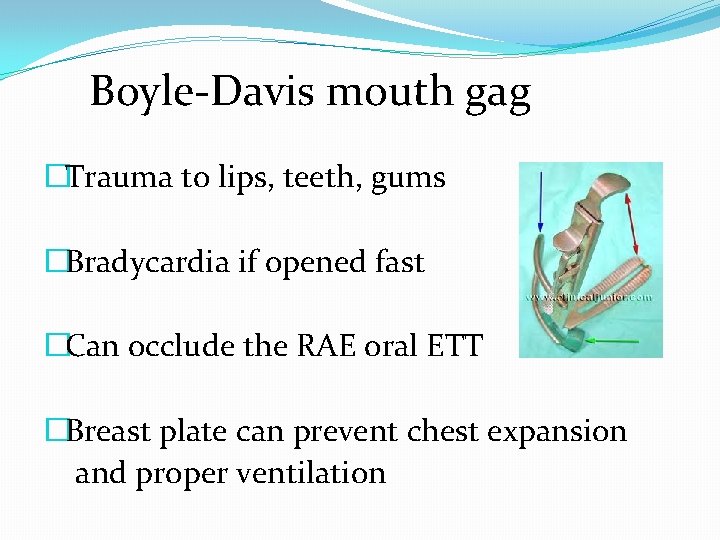 Boyle-Davis mouth gag �Trauma to lips, teeth, gums �Bradycardia if opened fast �Can occlude