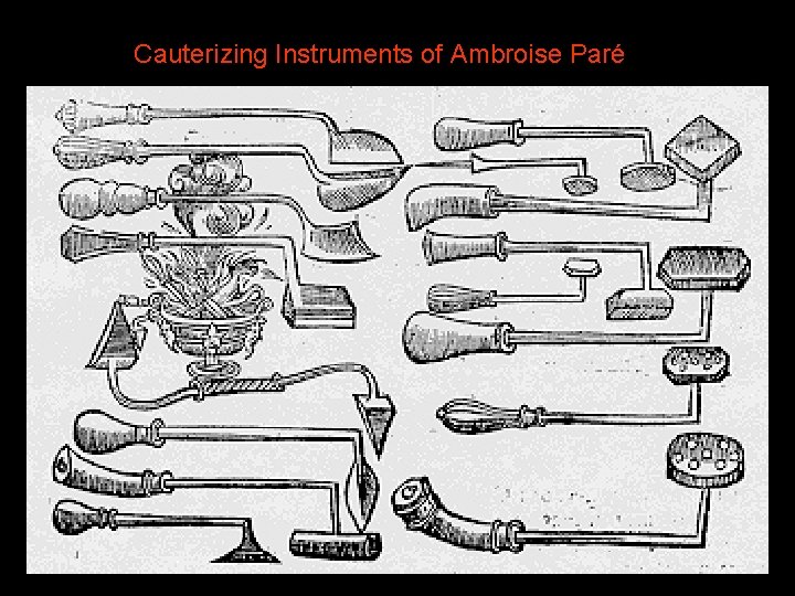 Cauterizing Instruments of Ambroise Paré 