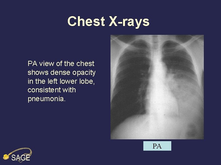 Chest X-rays PA view of the chest shows dense opacity in the left lower