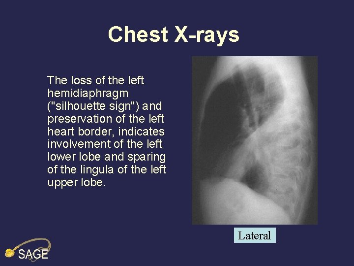 Chest X-rays The loss of the left hemidiaphragm ("silhouette sign") and preservation of the