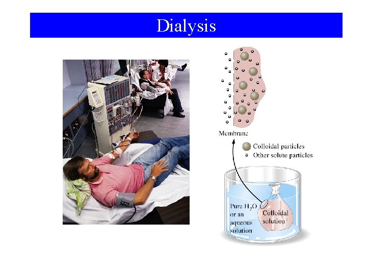 Dialysis 