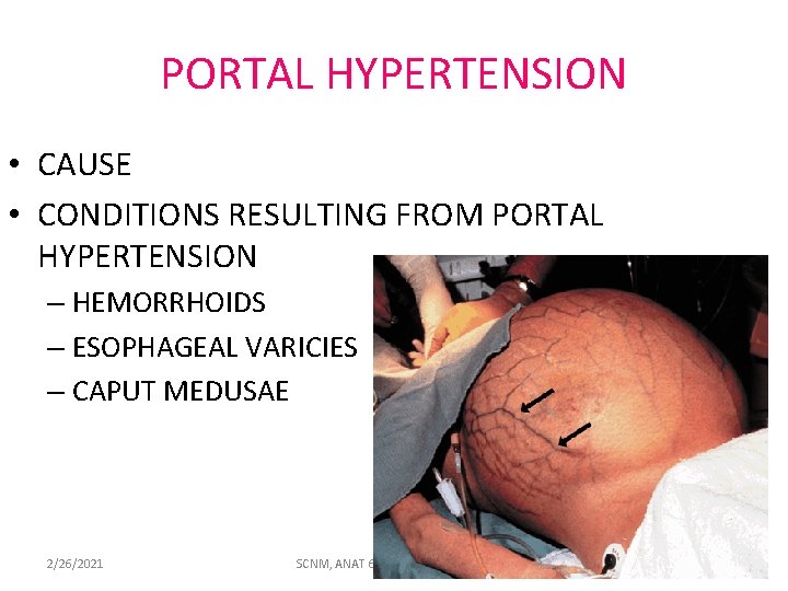 PORTAL HYPERTENSION • CAUSE • CONDITIONS RESULTING FROM PORTAL HYPERTENSION – HEMORRHOIDS – ESOPHAGEAL