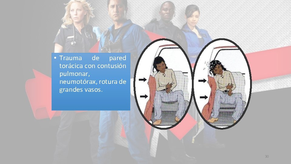  • Trauma de pared torácica contusión pulmonar, neumotórax, rotura de grandes vasos. 30