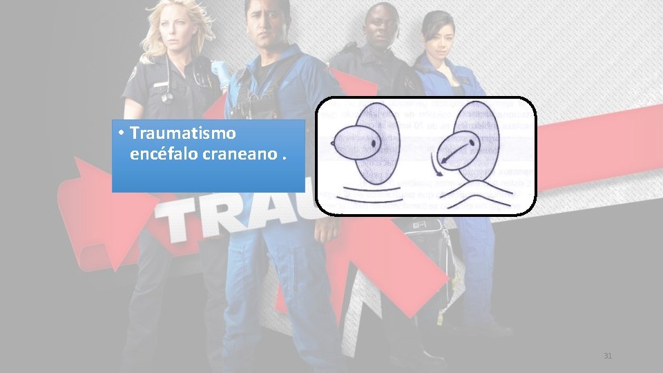  • Traumatismo encéfalo craneano. 31 