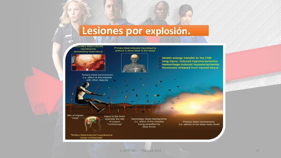 Lesiones por explosión. JL ARCE MD - TRAUMA 2016 47 