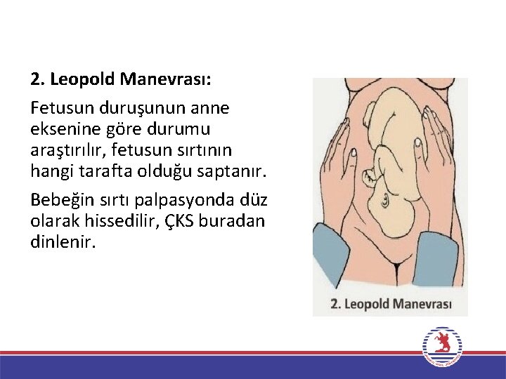2. Leopold Manevrası: Fetusun duruşunun anne eksenine göre durumu araştırılır, fetusun sırtının hangi tarafta