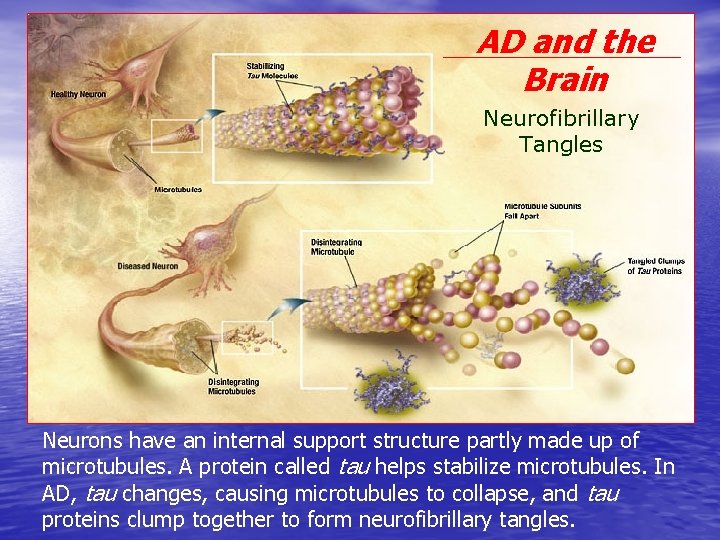 AD and the Brain Neurofibrillary Tangles Neurons have an internal support structure partly made