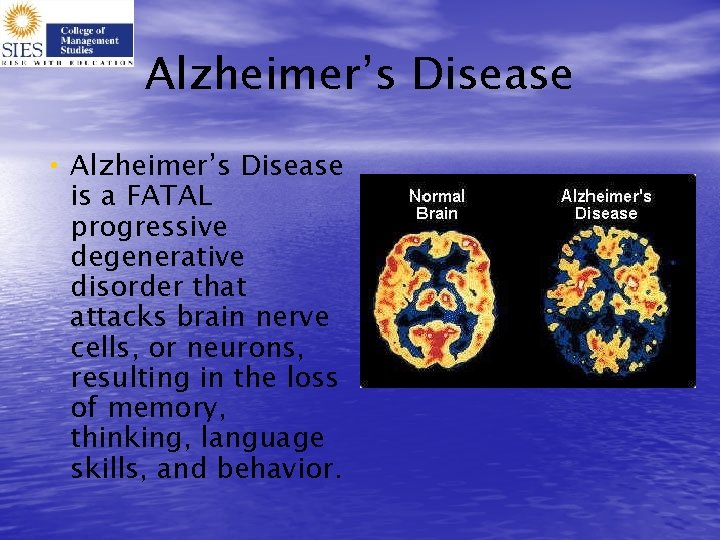 Alzheimer’s Disease • Alzheimer’s Disease is a FATAL progressive degenerative disorder that attacks brain