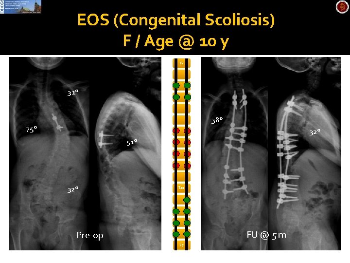 EOS (Congenital Scoliosis) F / Age @ 10 y T 1 31° 38° 75°