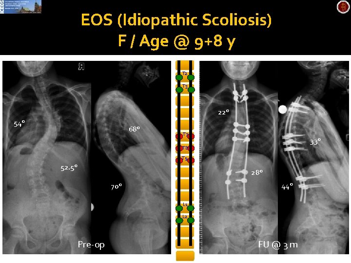 EOS (Idiopathic Scoliosis) F / Age @ 9+8 y T 2 T 3 22°
