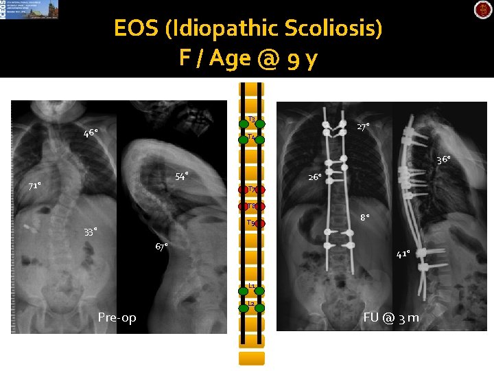 EOS (Idiopathic Scoliosis) F / Age @ 9 y T 3 46° 27° T
