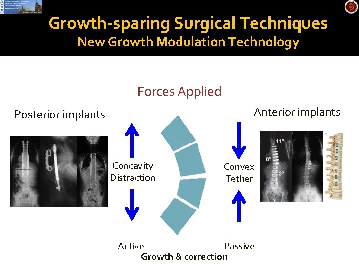 Growth-sparing Surgical Techniques New Growth Modulation Technology Forces Applied Anterior implants Posterior implants Concavity