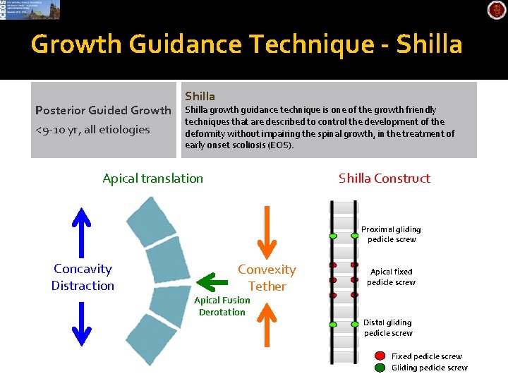 Growth Guidance Technique - Shilla Posterior Guided Growth <9 -10 yr, all etiologies Shilla