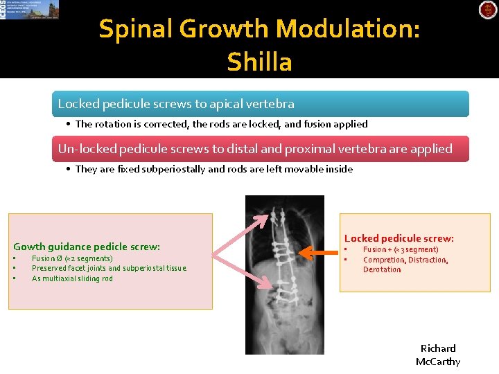 Spinal Growth Modulation: Shilla Locked pedicule screws to apical vertebra • The rotation is