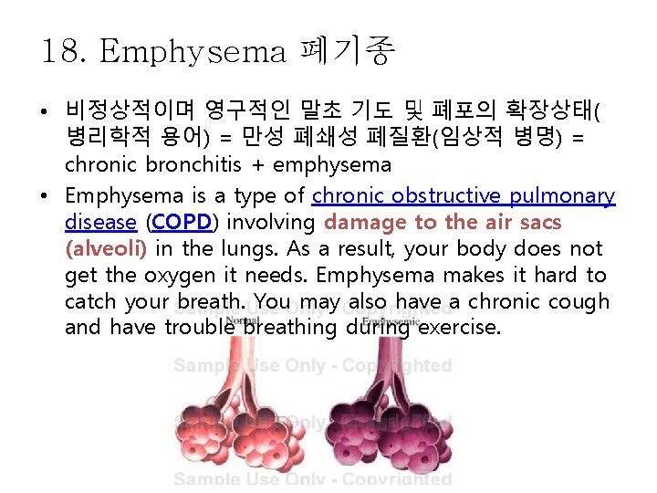 18. Emphysema 폐기종 • 비정상적이며 영구적인 말초 기도 및 폐포의 확장상태( 병리학적 용어) =