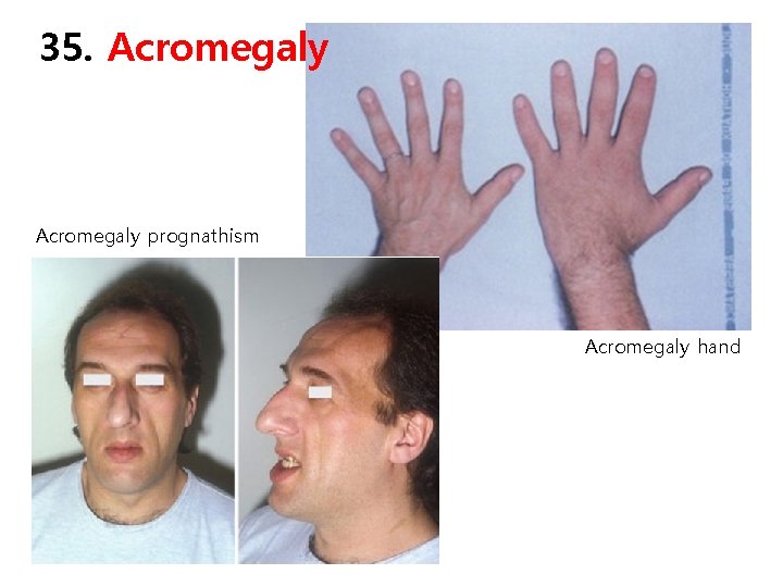 35. Acromegaly prognathism Acromegaly hand 
