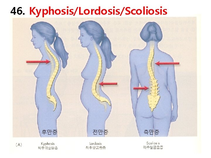 46. Kyphosis/Lordosis/Scoliosis 후만증 전만증 측만증 