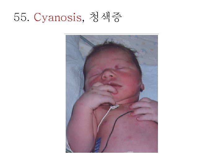 55. Cyanosis, 청색증 