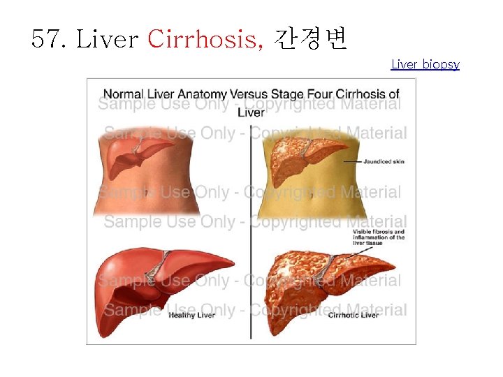 57. Liver Cirrhosis, 간경변 Liver biopsy 