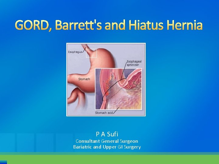 GORD, and Hiatus Hernia P A Sufi Consultant General Surgeon Bariatric and Upper GI