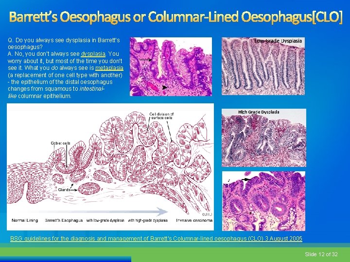 Q. Do you always see dysplasia in Barrett’s oesophagus? A. No, you don’t always