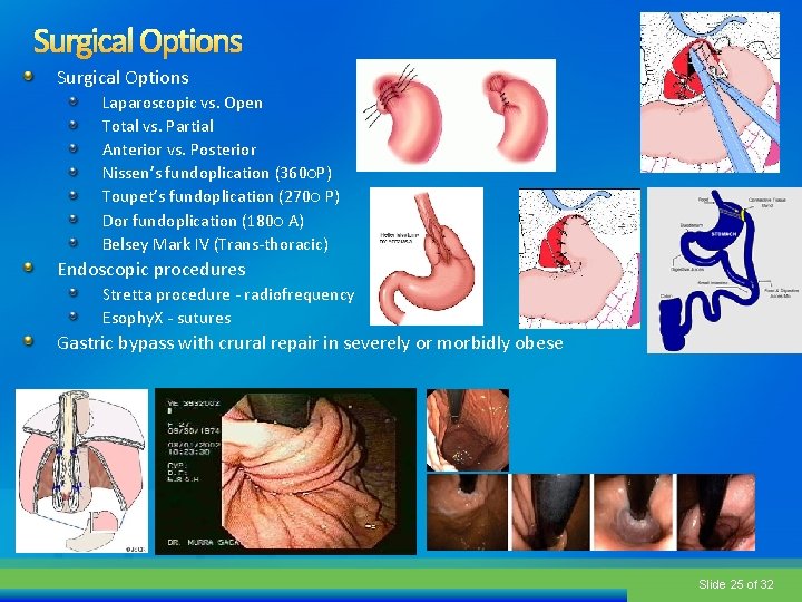 Surgical Options Laparoscopic vs. Open Total vs. Partial Anterior vs. Posterior Nissen’s fundoplication (360○P)