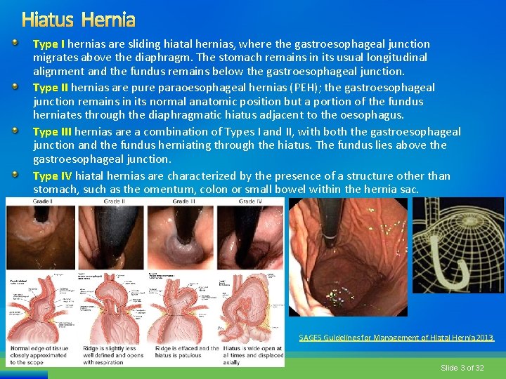 Hiatus Hernia Type I hernias are sliding hiatal hernias, where the gastroesophageal junction migrates